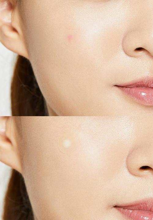 COSRX - Acne Pimple Master Patch