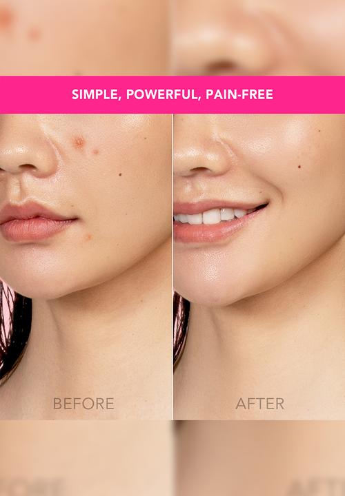 FOREO Sweden - ESPADA™ Acne Treatment - Fuchsia