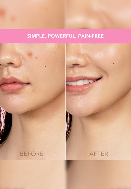 FOREO Sweden - ESPADA™ Acne Treatment - Pearl Pink