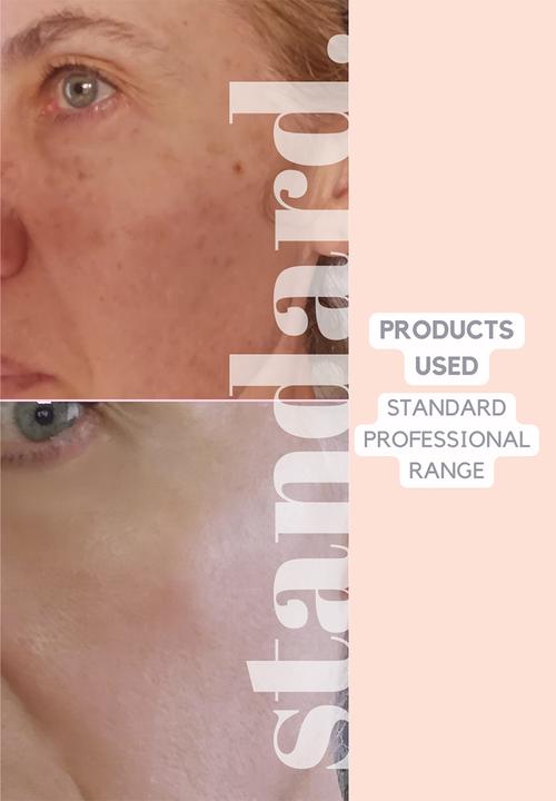 Standard Beauty - Spice N'Ice Double Masque For Resurfacing, Anti- Ageing, Pigmentation
