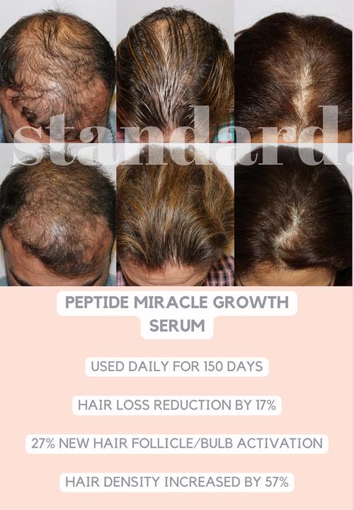 Standard Beauty - Miracle Growth Peptide Serum for Longer, Denser Hair in 150 days & Rosemary