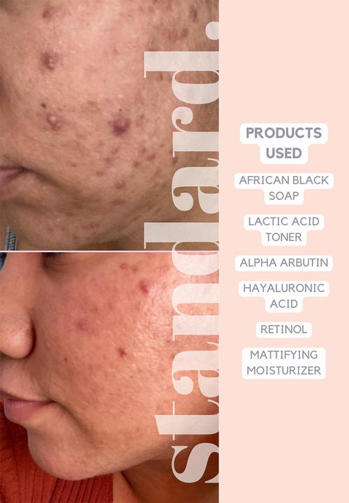 Standard Beauty - 1,5% Retinol Serum with Niacinamide & Hyaluronic Acid 