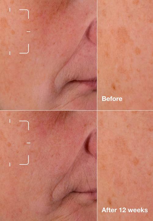 Clinique - Even Better Dark Spot Clearing Serum 30ml
