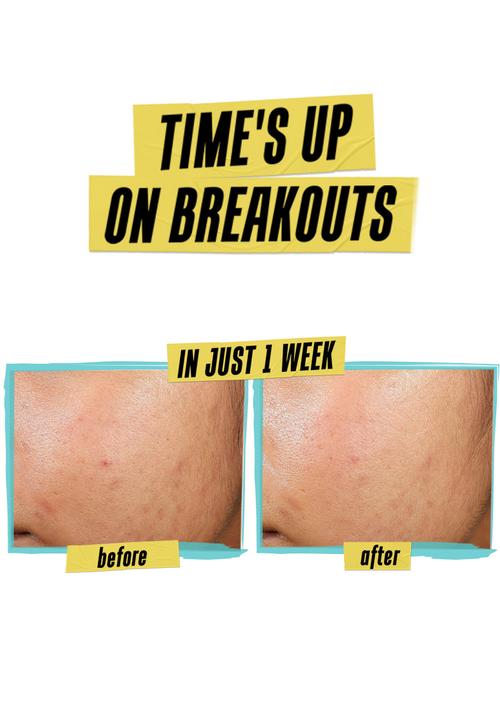Kiehl's - Expertly Clear Blemish-Treating & Preventing Lotion