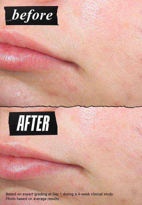 Kiehl's - Truly Targeted Blemish-Clearing Solution