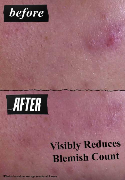 Kiehl's - Gently Effective Blemish-Treating Cleansing Paste
