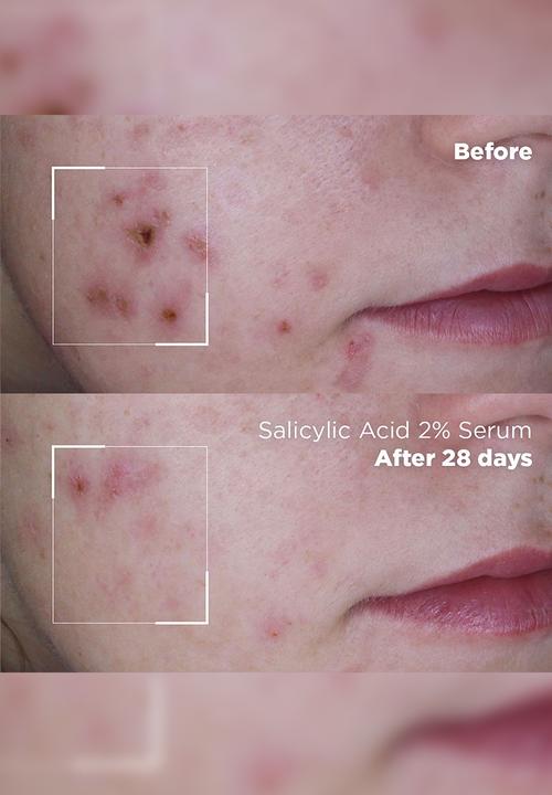 Skin Republic - Salicylic Acid 2% Serum