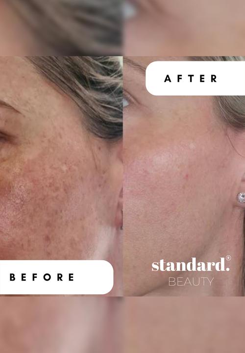 Standard Beauty - Advanced 0,3% Retinol with 1% Hyaluronic Acid & 2% Niacinamide
