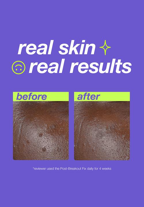 Clear Start by dermalogica - Cooling Aqua Jelly + Post Breakout Fix Bundle