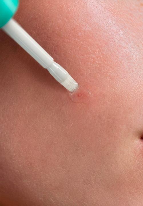NUXE - Zinc Power Spot Corrector - 10ml