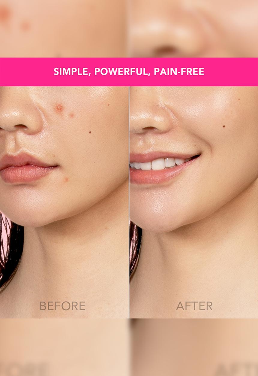 FOREO Sweden - ESPADA™ Acne Treatment - Fuchsia
