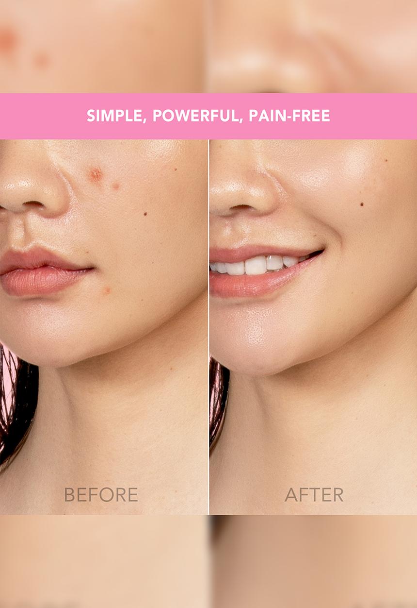 FOREO Sweden - ESPADA™ Acne Treatment - Pearl Pink