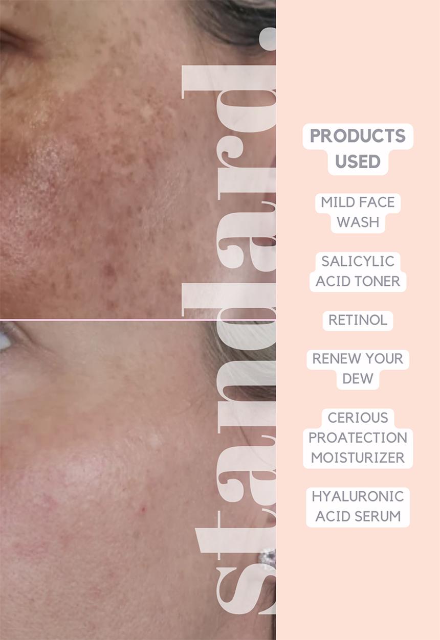 Standard Beauty - 0,3% Retinol Serum with Niacinamide & Hyaluronic Aicd 