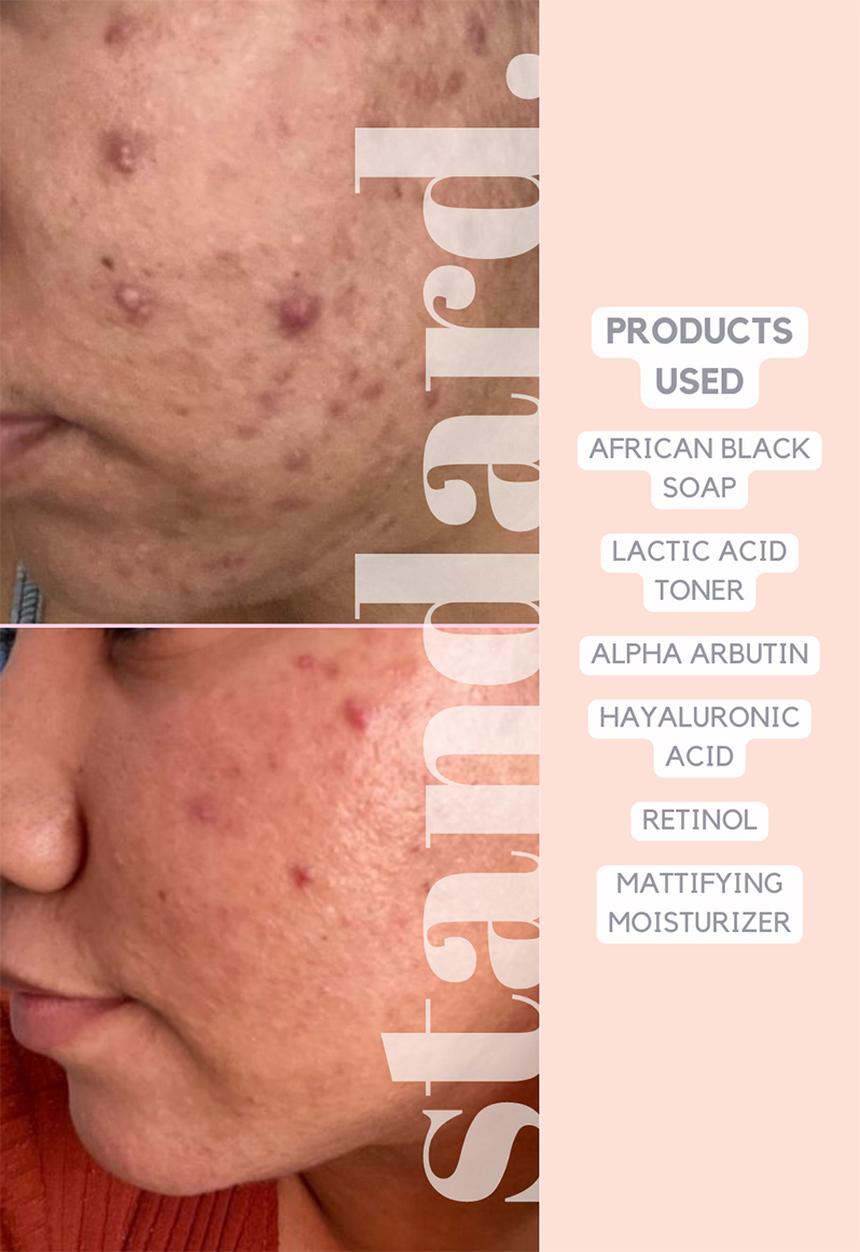 Standard Beauty - 1,5% Retinol Serum with Niacinamide & Hyaluronic Acid 