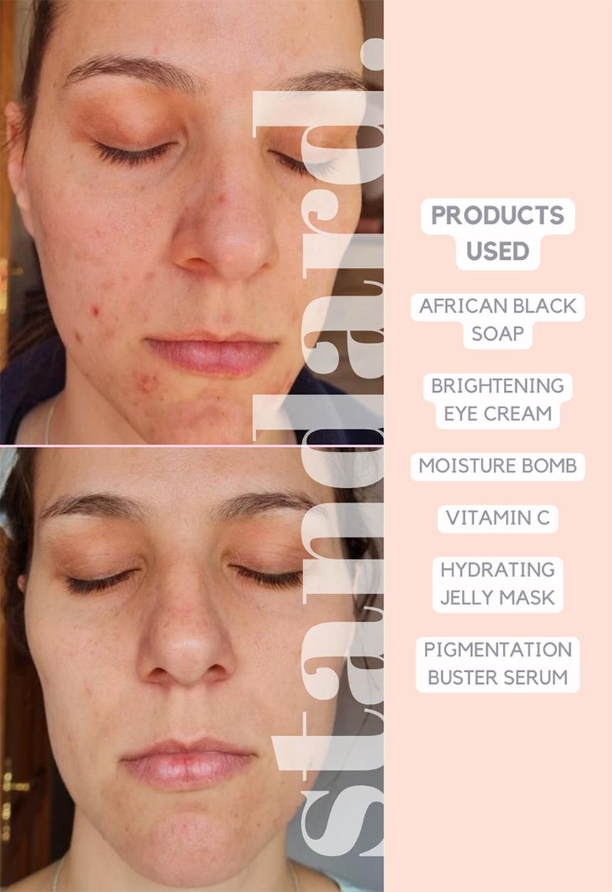 Standard Beauty - Pigmentation Buster Serum