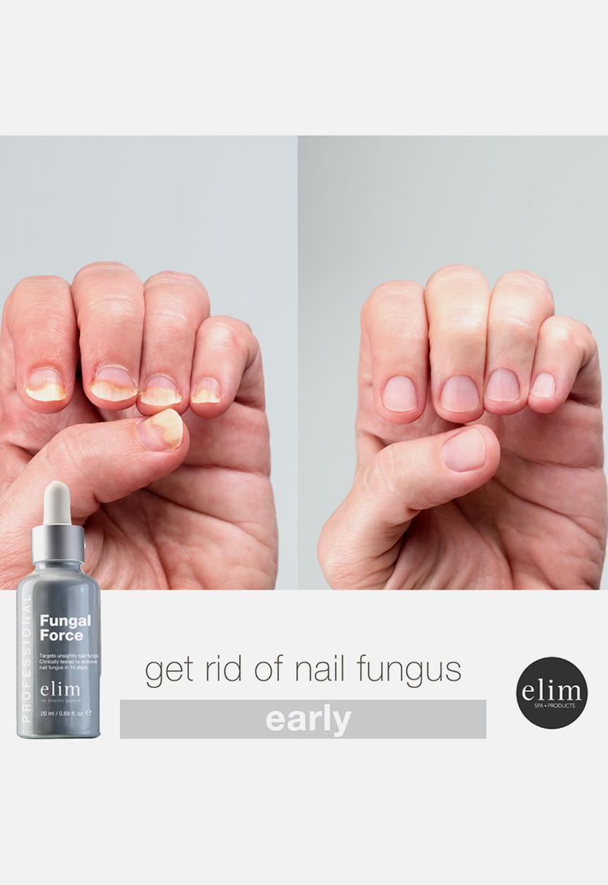 Elim - Fungal Force