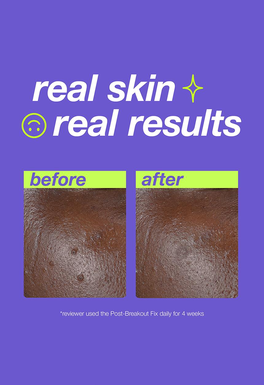 Clear Start by dermalogica - Cooling Aqua Jelly + Post Breakout Fix Bundle